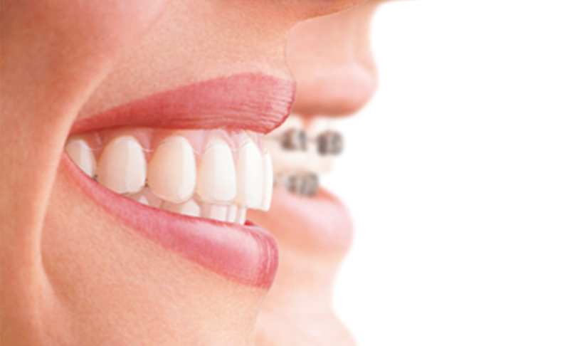 How to Take Care of Your Invisalign Trays: 54th Street Dental